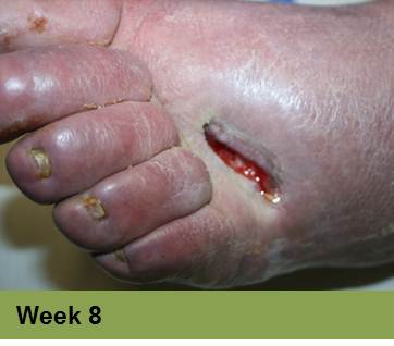 WINVIVO - Clinical Case Report Diabetic Foot Ulcers